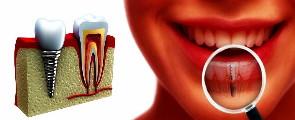 tratament-implant-dentar