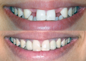 tratament-implant-dentar