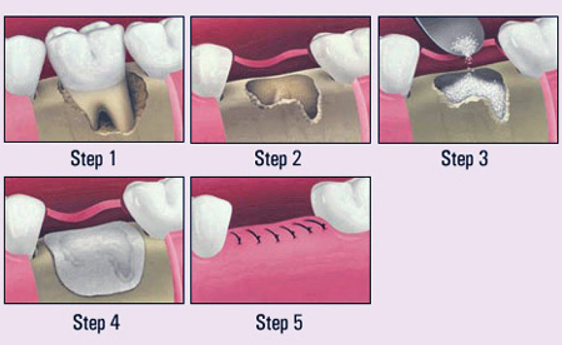 tratament-implant-dentar