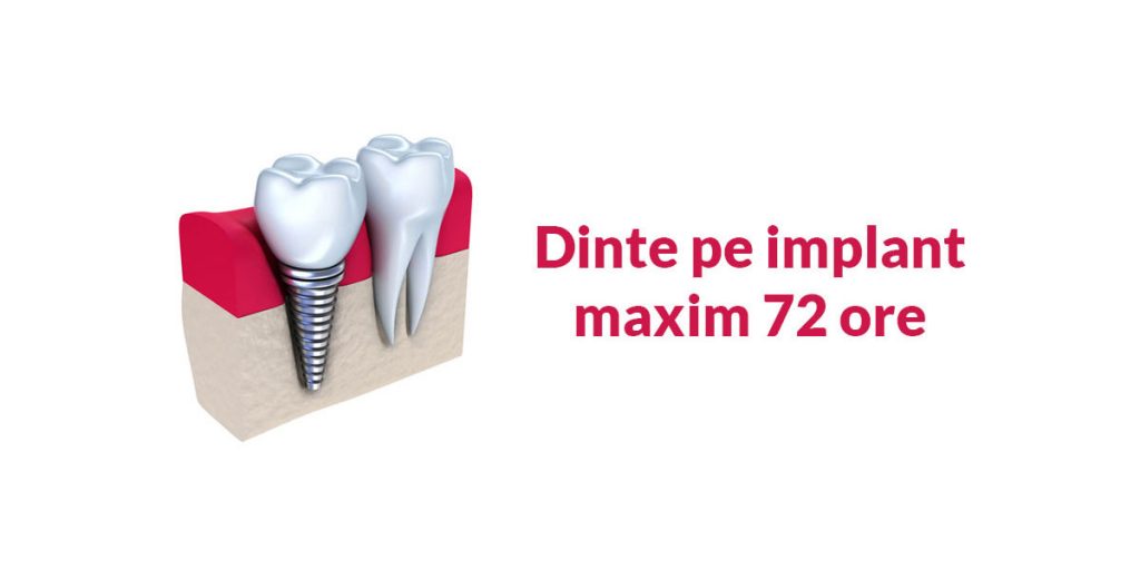 implant-dentar-72-ore
